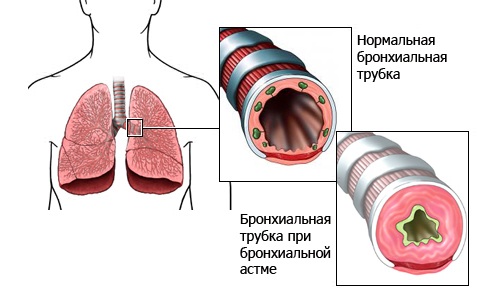 Астма бронхиальная