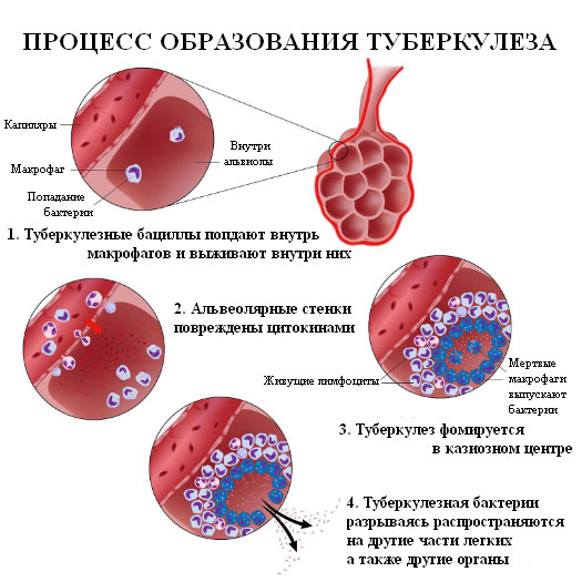 Туберкулез легких