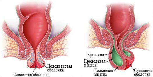 Выпадение прямой кишки