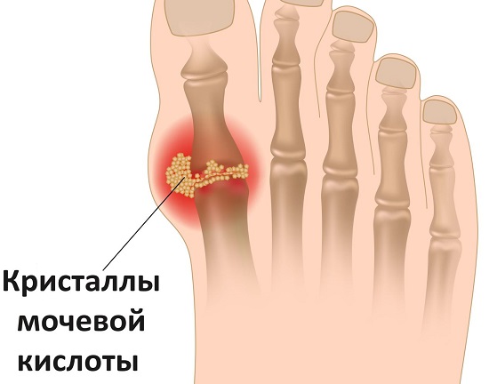 Подагра