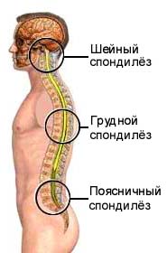 Спондилез