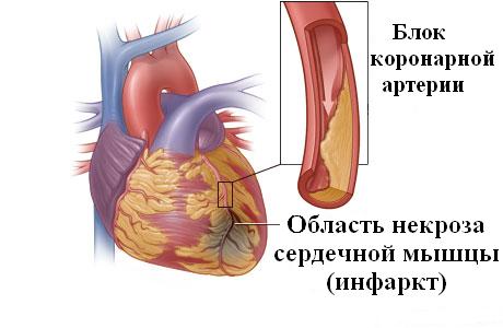 Инфаркт миокарда