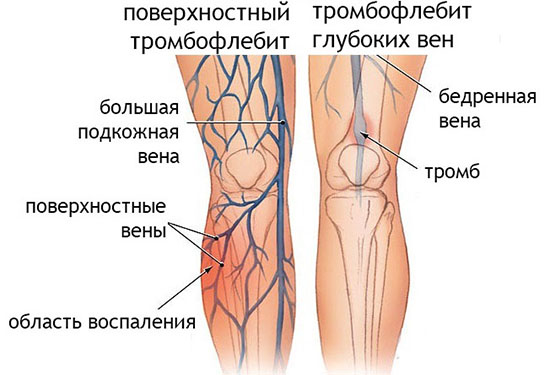 Тромбофлебит