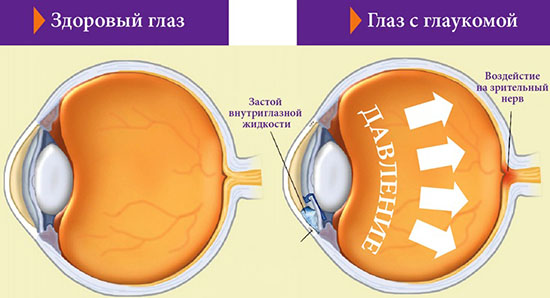Глаукома