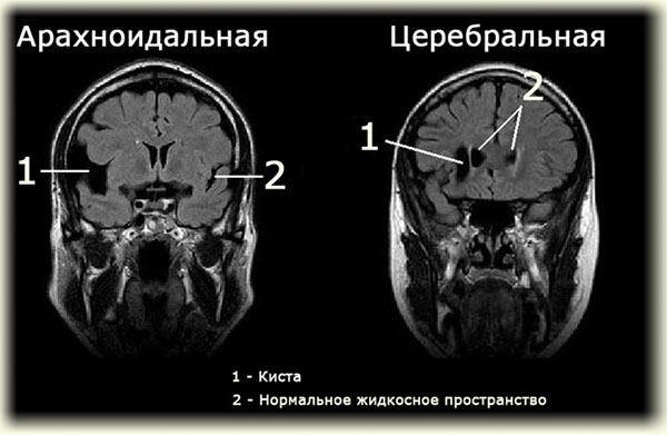 Киста головного мозга