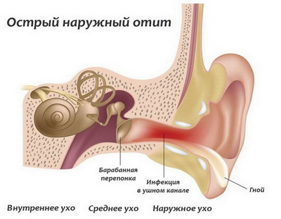 Отит