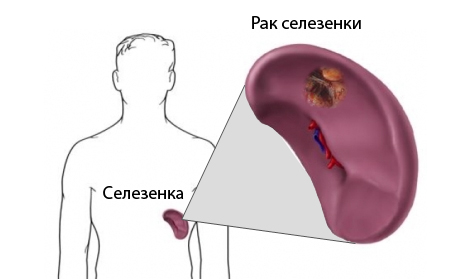 Рак селезенки