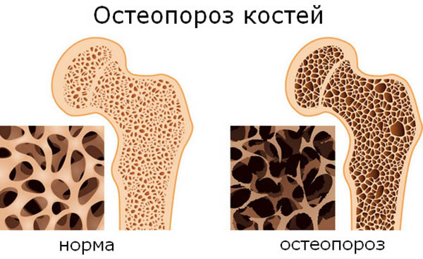 Остеопороз