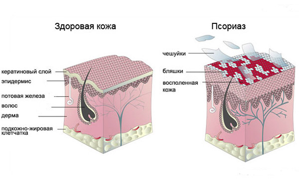 Псориаз