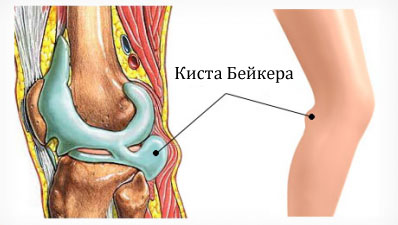 Киста Бейкера в коленном суставе