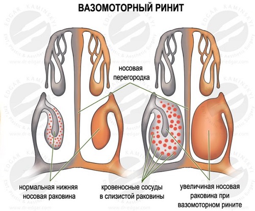 Вазомоторный ринит