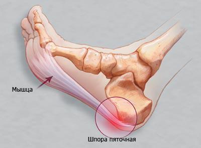 Шпора на пятке