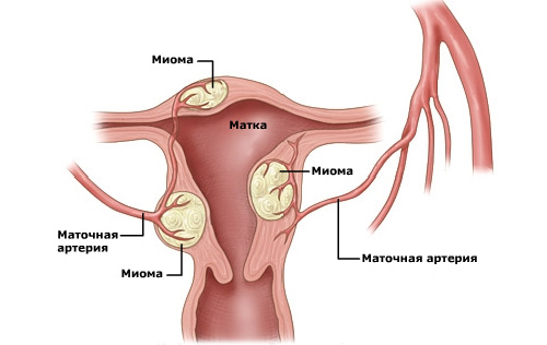 Фибромиома матки