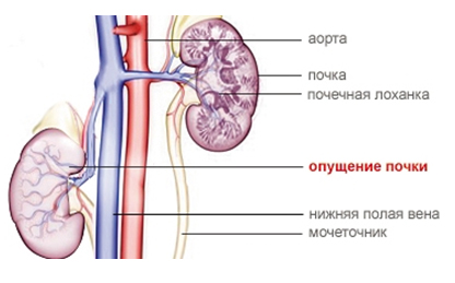 Опущение почки