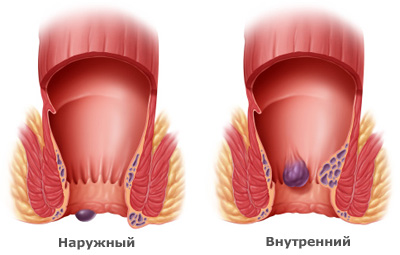 геморрой