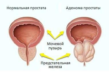Аденома предстательной железы