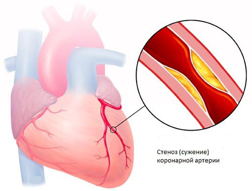 стенокардия и ишемия сердца