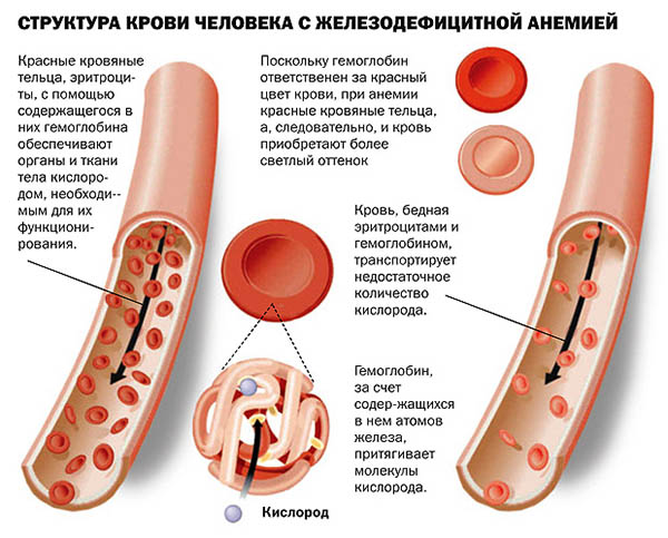 Железодефицитная анемия