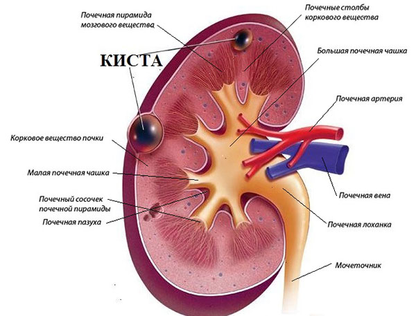 Почечная киста