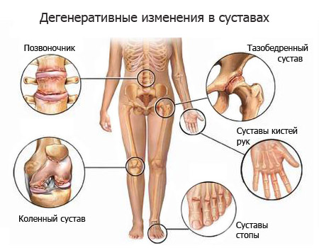 Дегенеративные изменения в суставах