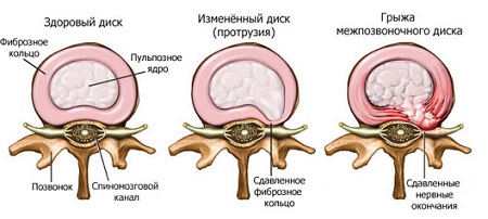 Грыжа межпозвоночная