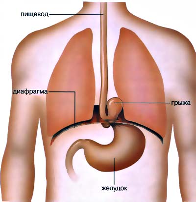 Грыжа диафрагмальная