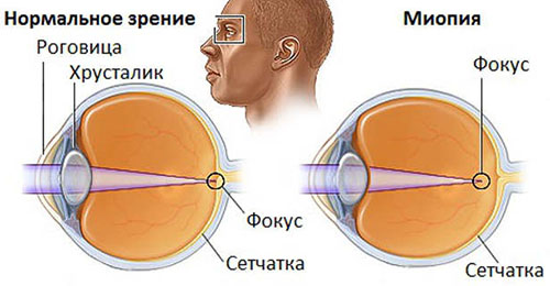 Миопия (Близорукость)