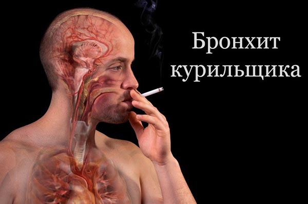 Бронхит курильщика