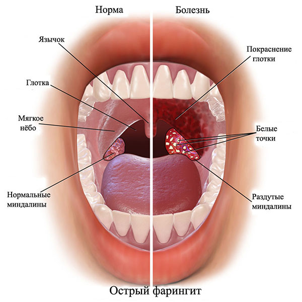 Фарингит, ларингит лечение народными средствами