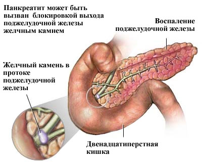 Панкреатит