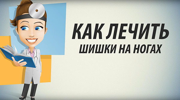 Как лечить шишки на ногах