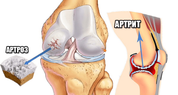 Артрит и артроз в чем разница